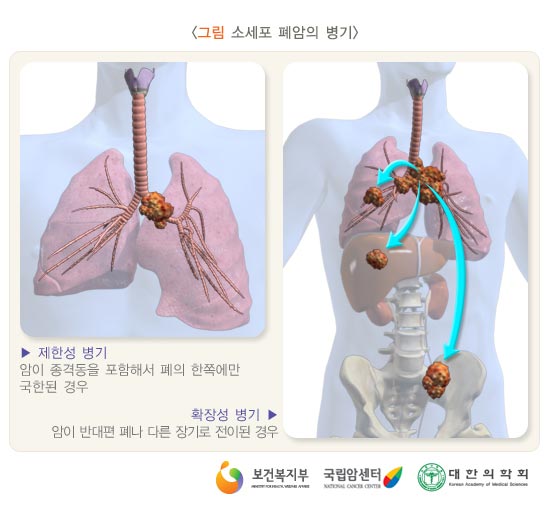비소세포암의 병기(소세포 폐암의 병기)