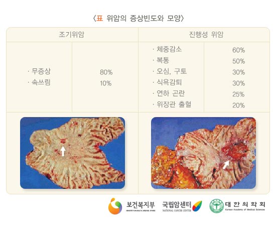 위암의 증상빈도와 모양