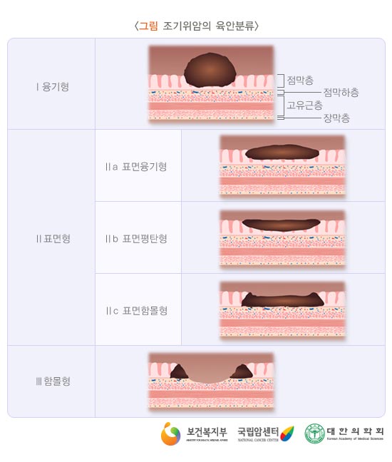 조기위암의 육안분류
