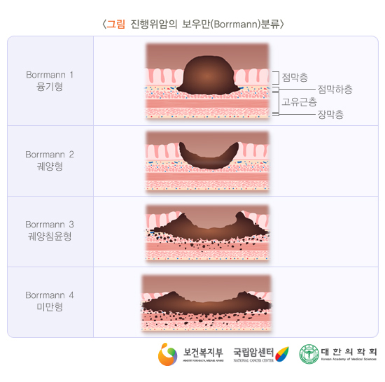  츸(Borrmann)з