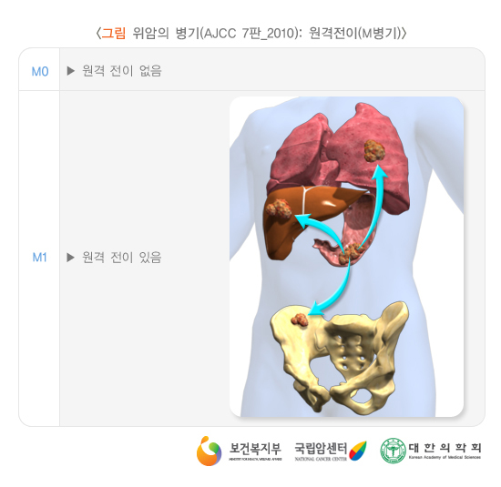 위암의 병기(AJCC 7판_2010) : 원격전이(M병기)