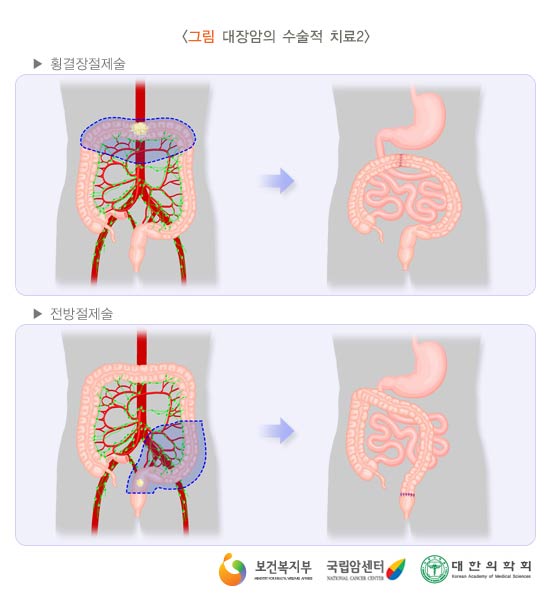 대장암의 수술적 치료2
