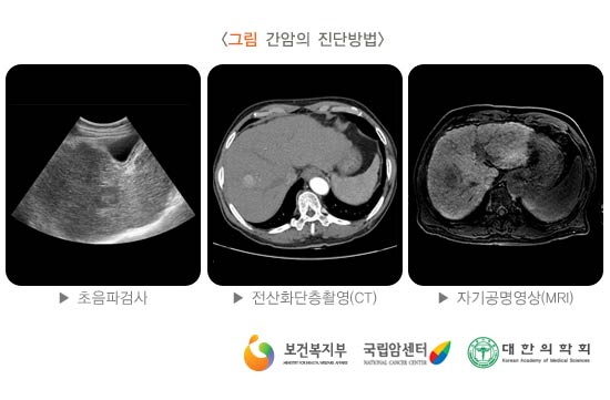 간암의 진단방법