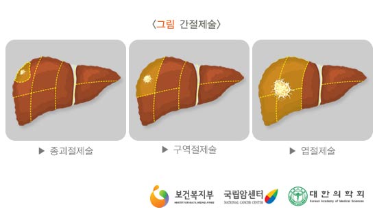 간절제술