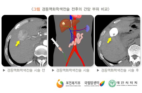 경동맥 화학색전술 전후의 간암부위 비교