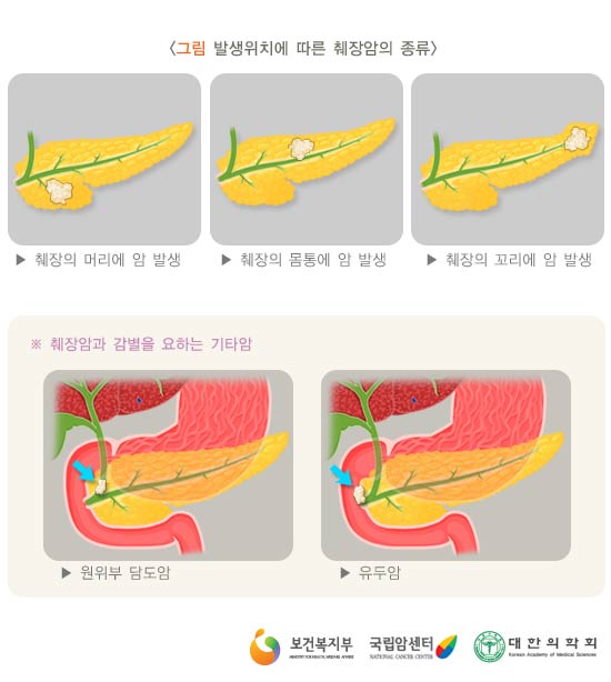 발생위치에 따른 췌장암의 종류