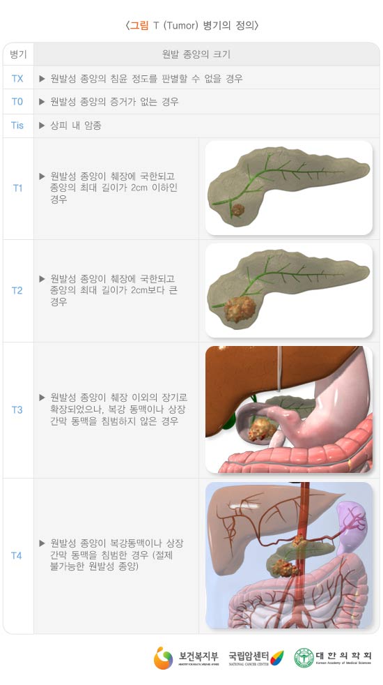 T(Tumor) 병기의 정의