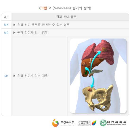 M(Metastasis)  