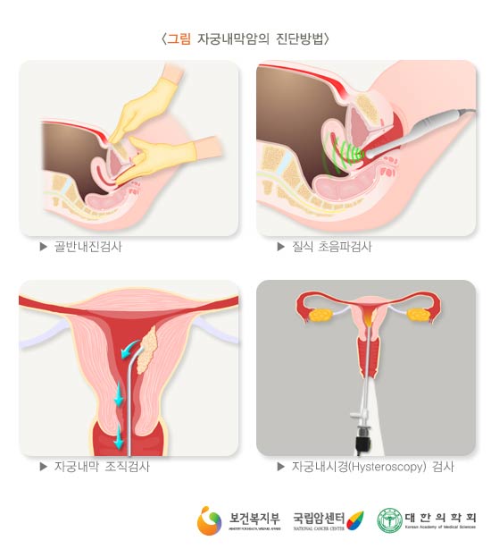 자궁내막암의 진단방법