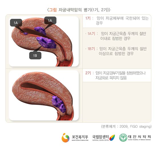 자궁내막암의 병기(1기, 2기)