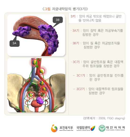 자궁내막암의 병기(3기)