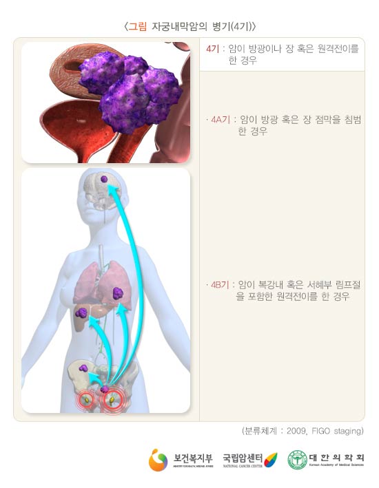자궁내막암의 병기(4기)