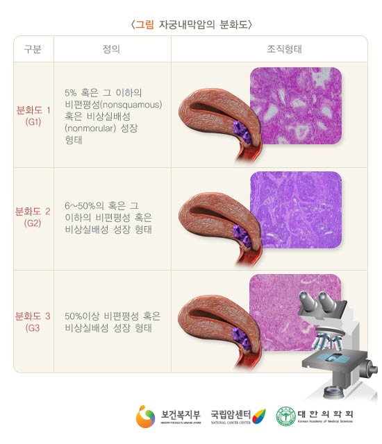 자궁내막암의 분화도